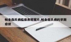 帕金森氏病临床表现图片,帕金森氏病的早期症状